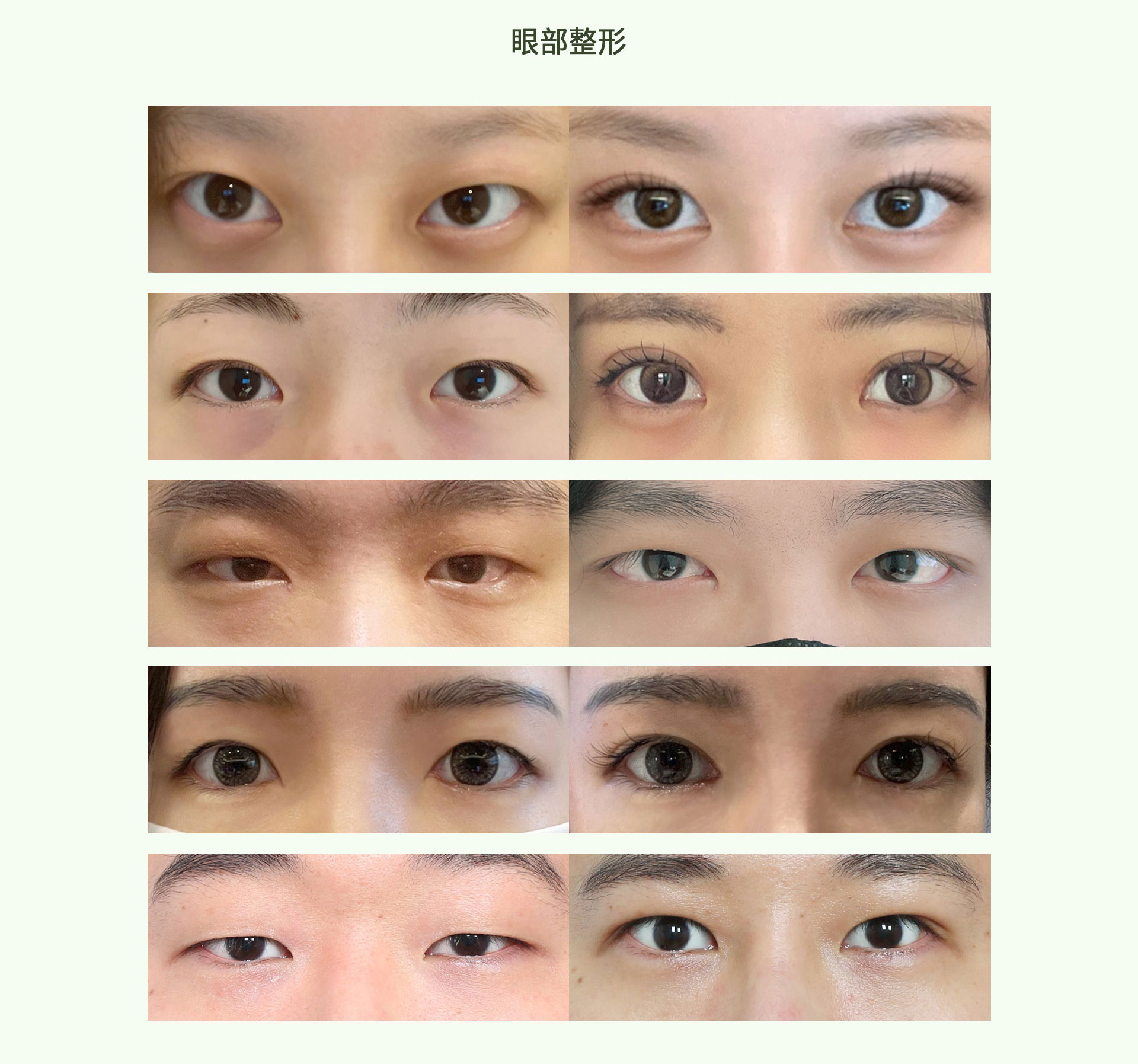 手术前后整形后记——眼睛