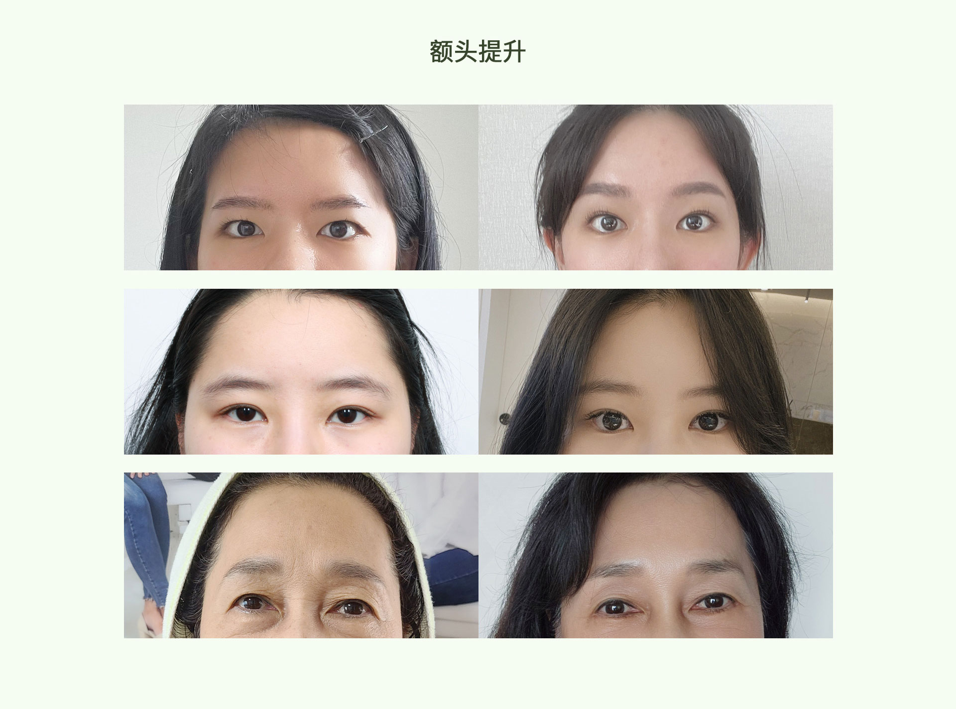 手术前后整形后记——额头提升