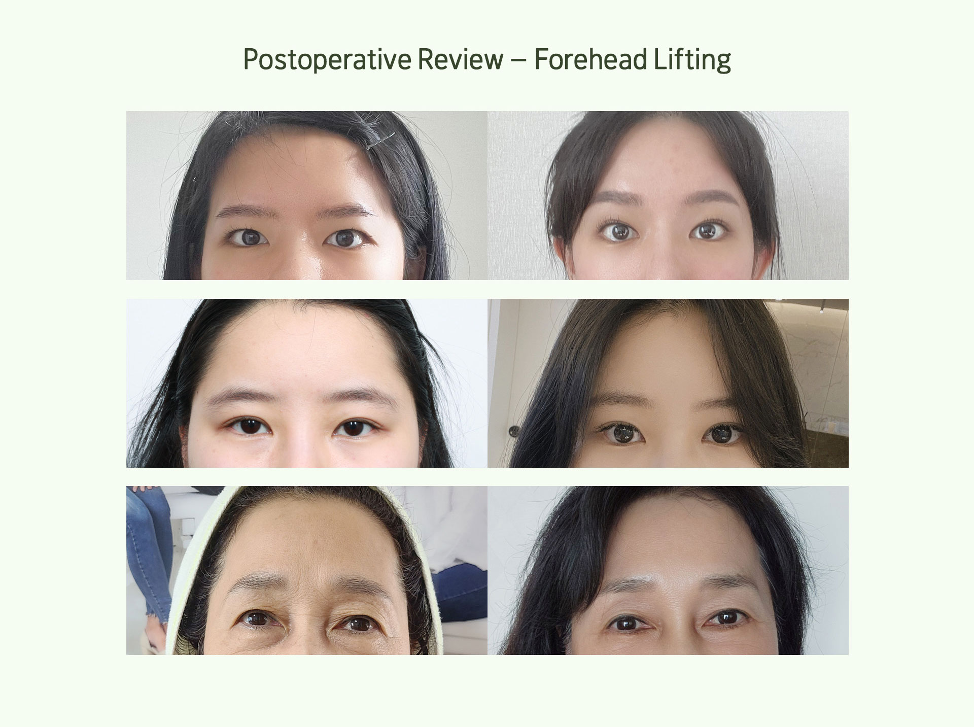 Postoperative Review – Forehead Lifting
